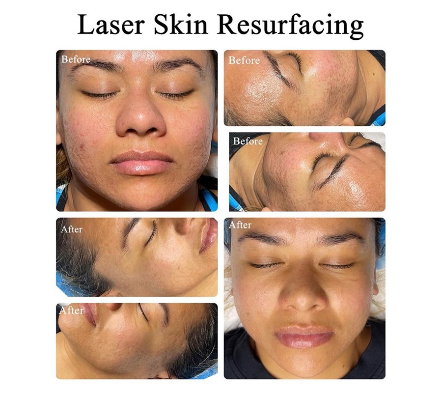 How to Know What Laser Treatment is Right for You