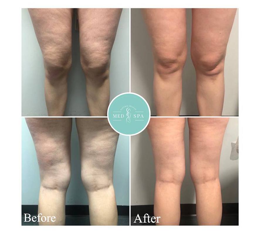 Endermologie Lipomassage Chicago, Cellulite Solutions