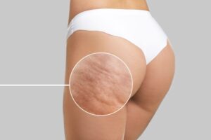 Close-up of cellulite on back of woman’s thigh 