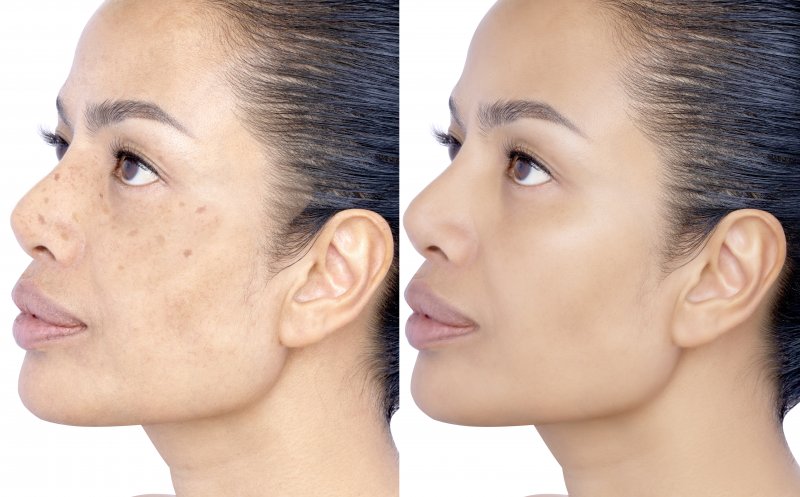 a before and after image of a woman with age spots