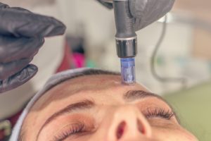 Close-up of woman relaxing during Microneedling in Chicago